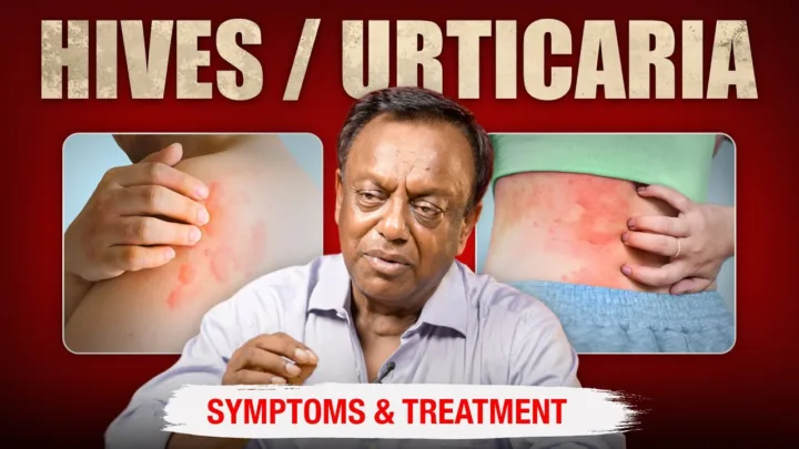 Beyond the Itch: An Ayurvedic Guide to Healing Chronic Hives